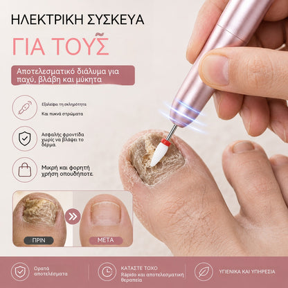 💅👍 Ηλεκτρική λίμα νυχιών για την αντιμετώπιση της ονυχομυκητίασης